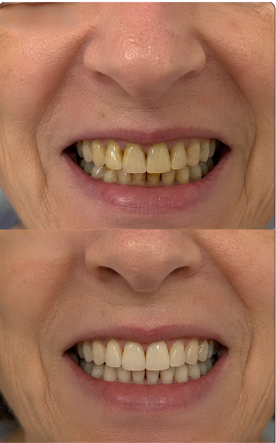 Before and after using LumiSmile