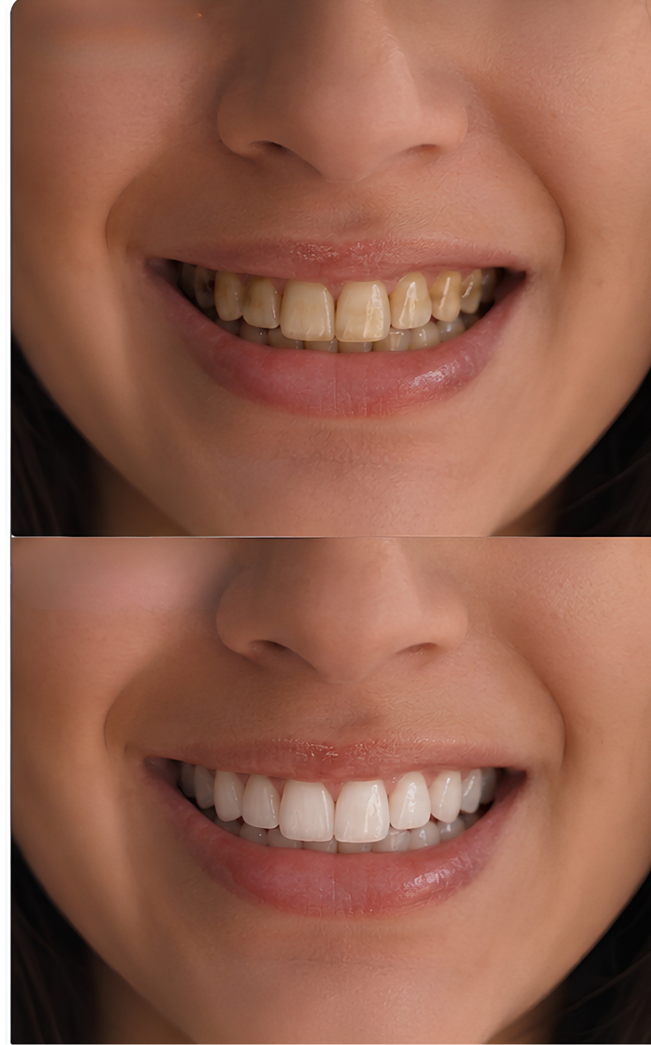Before and after using LumiSmile
